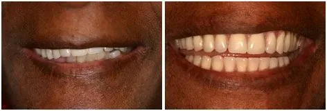 Before and after smile transformation 1 by prosthodontist Dr. Adibe at Clearbrook Advanced Dental Care in Cranbury, NJ