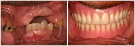 Before and after smile transformation 2 by prosthodontist Dr. Adibe at Clearbrook Advanced Dental Care in Cranbury, NJ