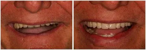 Before and after smile transformation 3 by prosthodontist Dr. Adibe at Clearbrook Advanced Dental Care in Cranbury, NJ