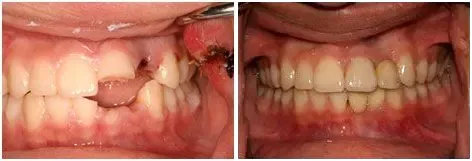 Before and after smile transformation 4 by prosthodontist Dr. Adibe at Clearbrook Advanced Dental Care in Cranbury, NJ