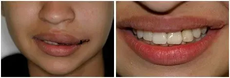 Before and after smile transformation 5 by prosthodontist Dr. Adibe at Clearbrook Advanced Dental Care in Cranbury, NJ