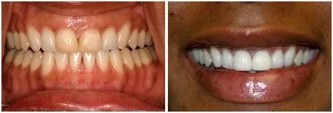 Before and after smile transformation 6 by prosthodontist Dr. Adibe at Clearbrook Advanced Dental Care in Cranbury, NJ