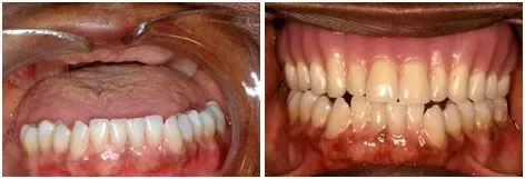 Before and after custom dentures: Gaps Filled with a Partial at Clearbrook Advanced Dental Care in Cranbury, NJ