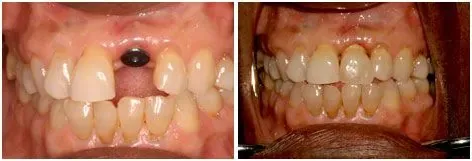 Before and after dental implant result: Full-Arch Restoration at Clearbrook Advanced Dental Care in Cranbury, NJ