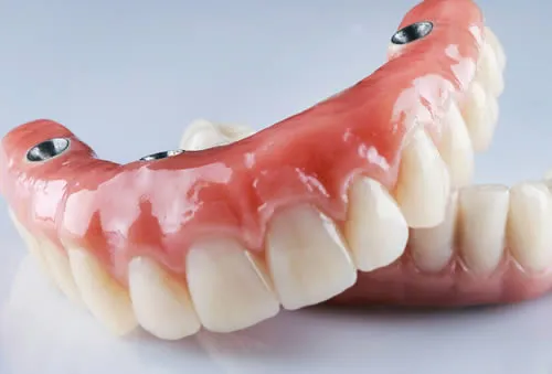 Full-arch fixed implant restoration on four implants