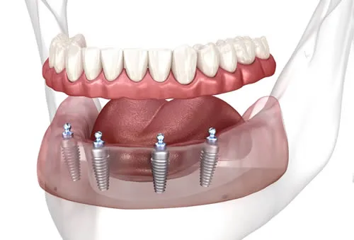 Snap-on implant-retained denture (overdenture)
