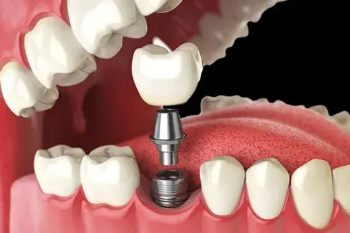 Single dental implant replacing one missing tooth