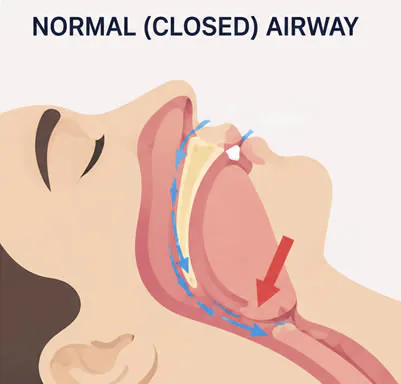 Diagram of a normal closed upper airway during sleep apnea — the soft tissue collapses and blocks airflow