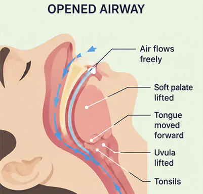Diagram of an opened upper airway during sleep — air flows freely past the soft palate, tongue, and uvula