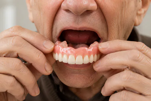 Custom complete denture