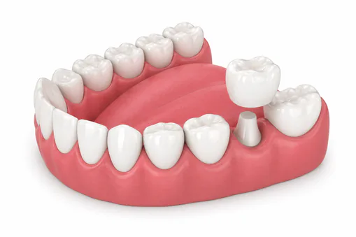 Custom dental crown